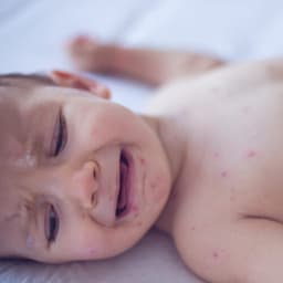 Pennsylvania alerts doctors as measles in pregnancy and congenital measles return after decades